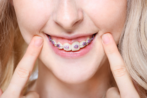 What Are The Risks Of DIY Braces