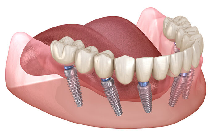 A Guide to All-On-6-Dental Implants
