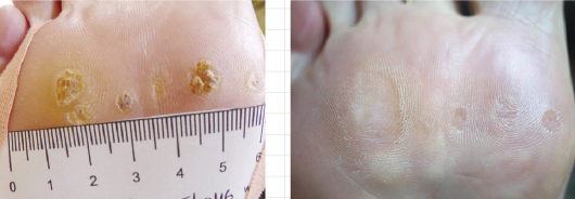 Best Treatment Method for Warts on Legs