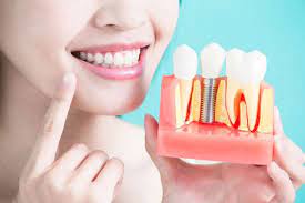 What are Dental Implants and Why You Should Consider Getting Them Done