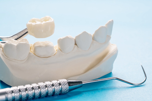 Getting Dental Bridges – Little Effort To Improve Your Aesthetic Smile