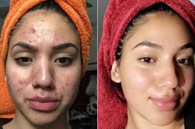 Severe Acne