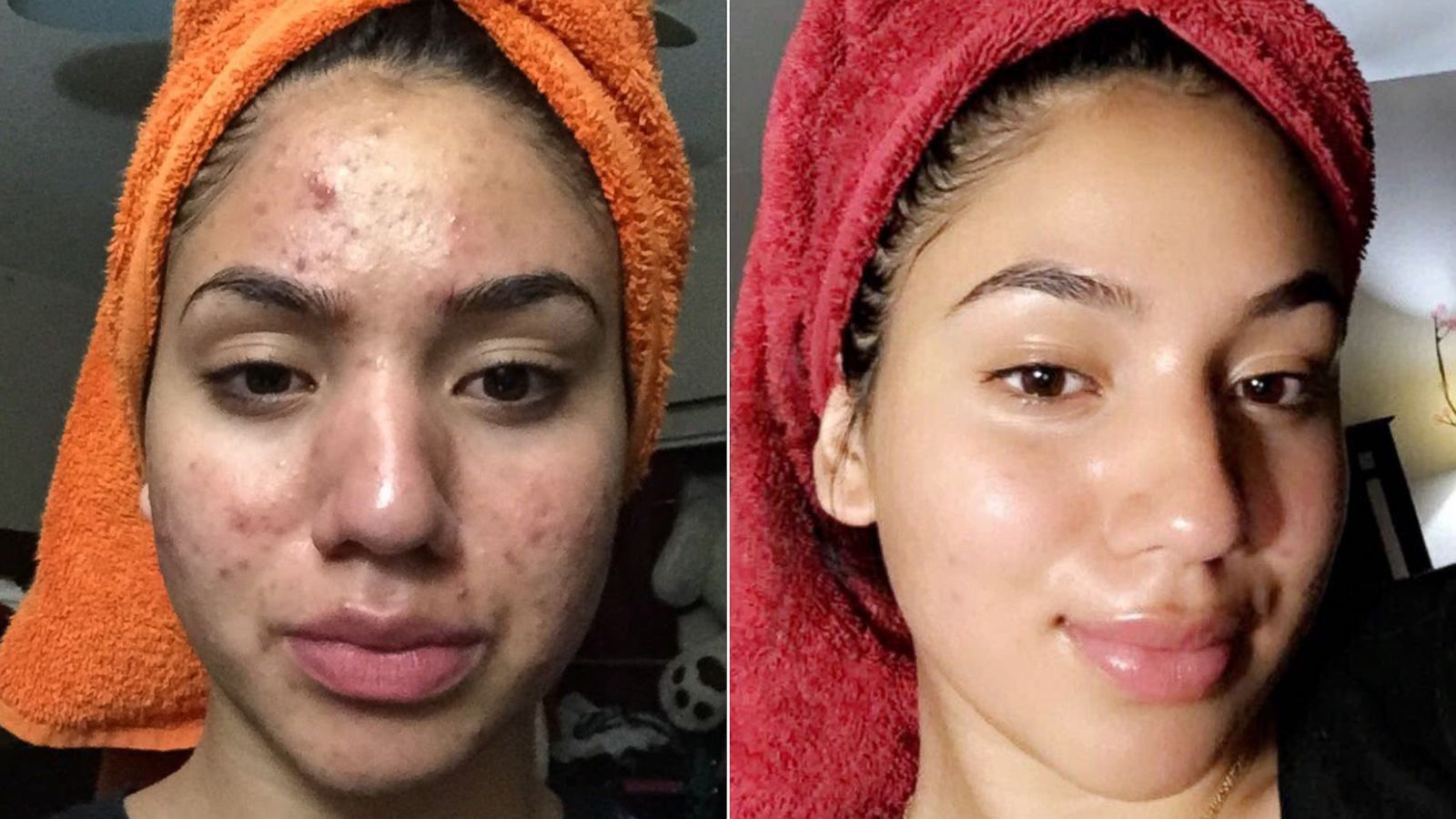 Severe Acne
